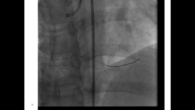 PRIMARY PCI 2013: DISTAL EMBOLIZATION. PART 4 (русский) смотреть онлайн