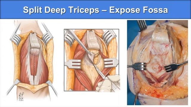 Why Use A Triceps Approach For Elbow Trauma? How To Perform A Triceps Tongue Approach