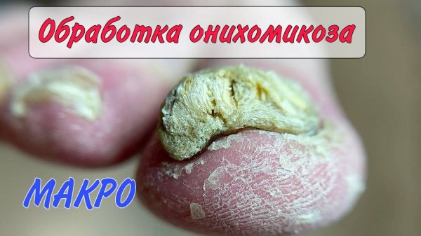 🍄ГРИБОК ногтей _ ОНИХОМИКОЗ _ медицинский педикюр