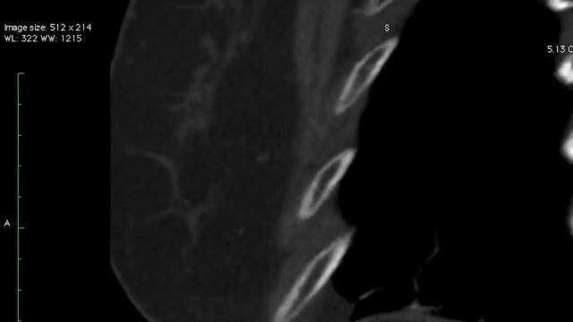 TMT: MEDIASTINAL CALCIFICATION CASE BASED REVIEW смотреть онлайн