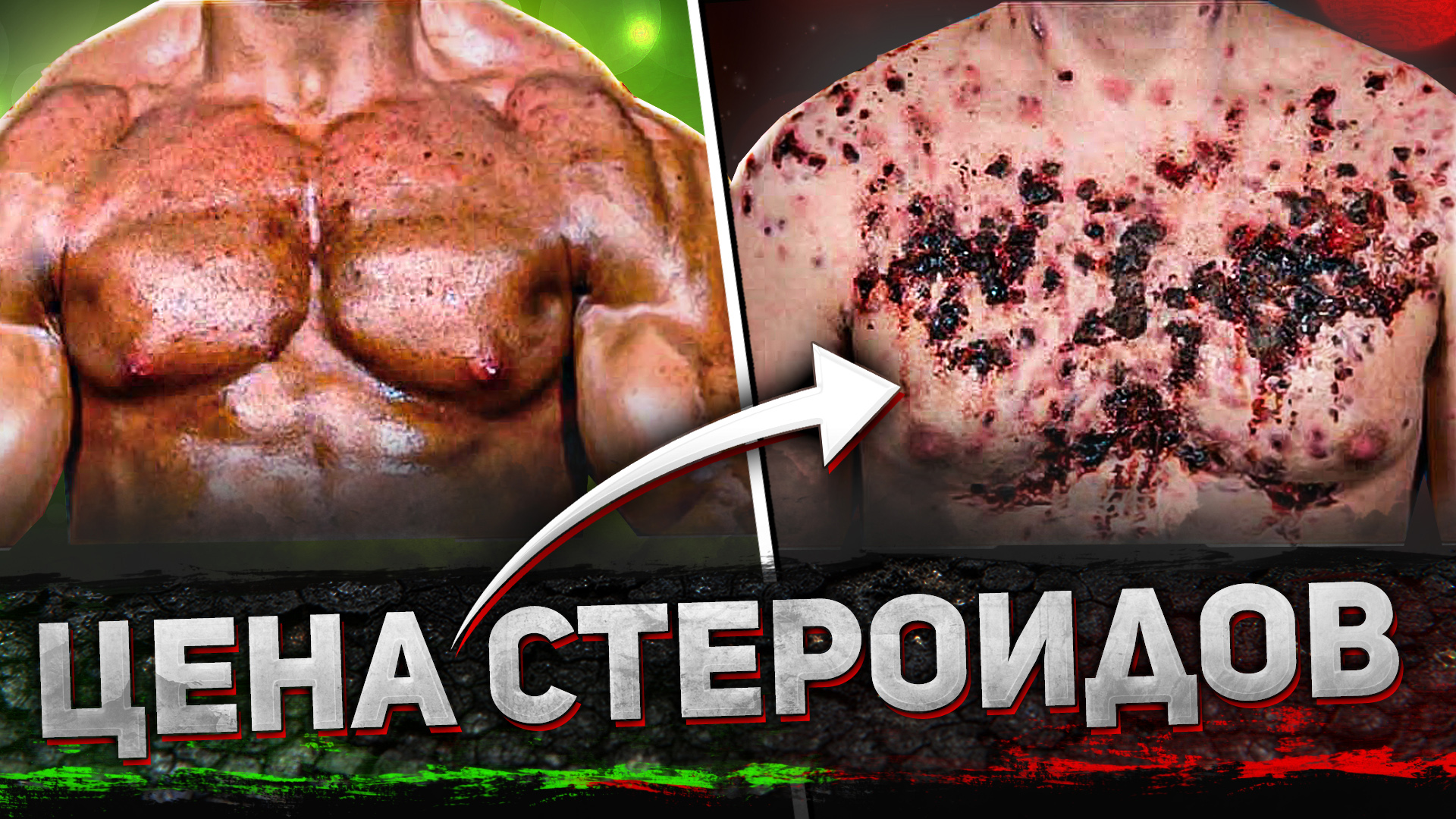 ГНИЮЩАЯ КОЖА СЛАЗИЛА ОТ ХИМИИ! ОБРЫВКИ ПАМЯТИ БЫВШЕГО КАЧКА смотреть онлайн