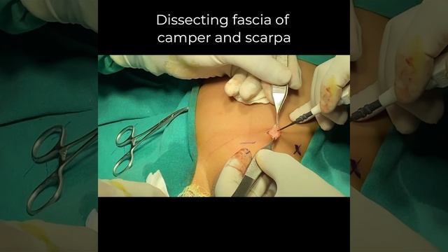 Umbilical Hernia & Left Inguinal Hernia Repair In A 2 Year Old Boy : Dr Kirti Prajapati, Ahmedabad