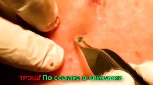 Прыщи на спине! Выдавливание прыщей,выдавливание черных точек!
