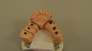 Протезирование на имплантах мультиюниты плюс классическая винтовая фиксация