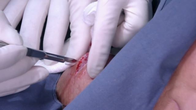 Dr. Sandra Lee Faces Her Biggest Cyst Yet! | Dr. Pimple Popper смотреть онлайн