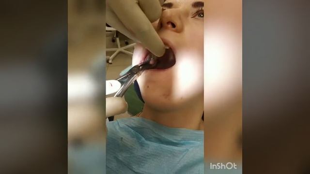 Удаление восьмёрки (зуба мудрости ) все этапы )