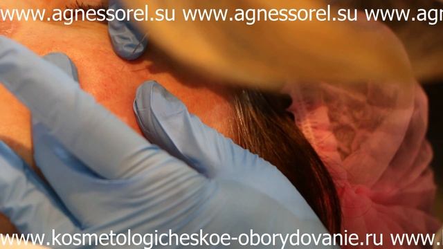 Косметологическое  Оборудование Ру - Коагулятор косметологический