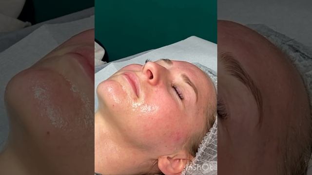 Chemische Peeling, химический пилинг , фруктовая кислота. Показываю процесс. смотреть онлайн