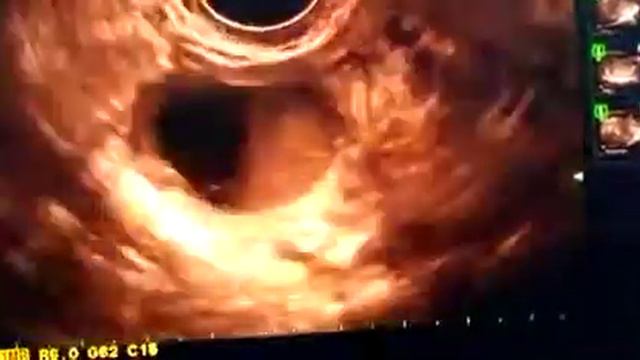 Endometriotic cyst showing fluid fluid level смотреть онлайн
