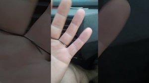 Как вылечить ячмень на глазу