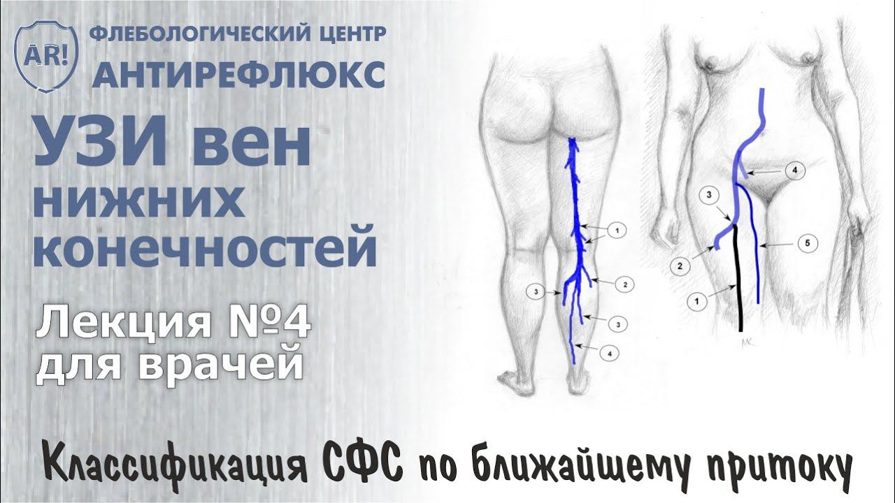 УЗИ вен. Классификация СФС по ближайшему притоку смотреть онлайн