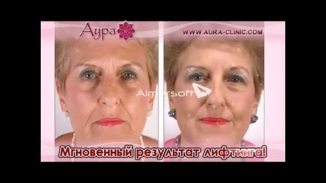 3D-мезонити от центра лазерной косметологии Аура смотреть онлайн