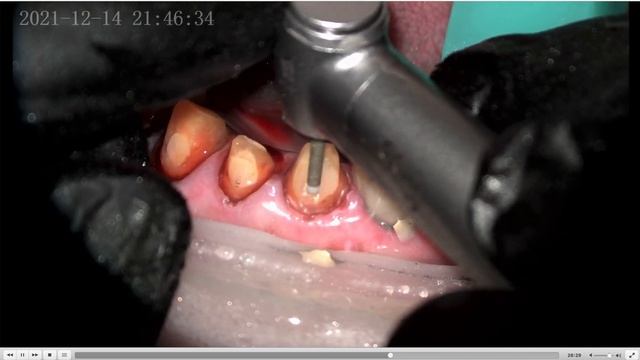 Клинический случай #25 снимаем мостовидные протезы и переливаем резорцин... смотреть онлайн