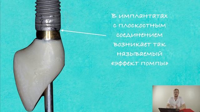 Видео для начинающих №4. Про имплантаты. смотреть онлайн
