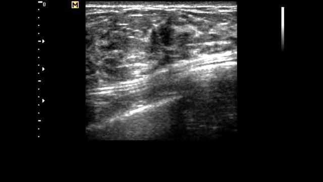 Fibroadenoma right breast | Breast Lump смотреть онлайн