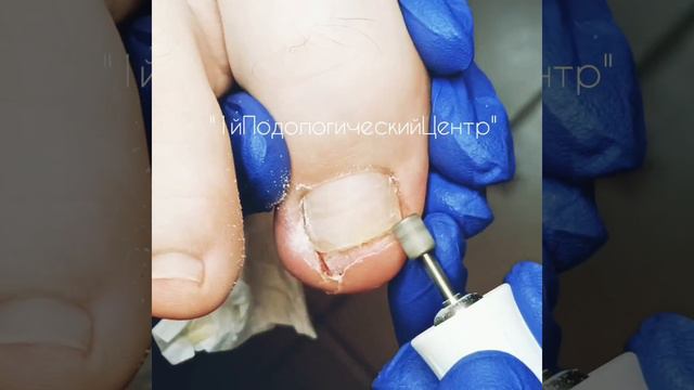 Вросший ноготь. Работа специалиста подолога в 