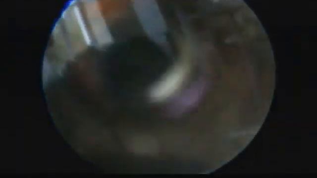 Postreior Corn Medial Resection And Arthroscopic Threatment Bekker Cyst