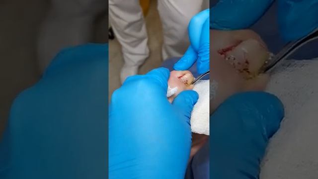 Коррекция вросшего ногтя - этап удаления вросшего сегмента в мягкие ткани пальца при онихокриптозе. смотреть онлайн