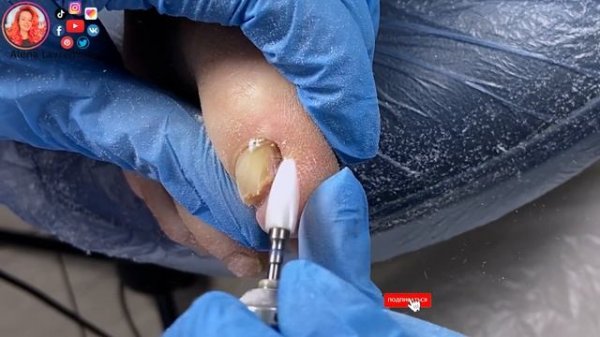 Онихогрифоз / Толстый ноготь на большом пальце