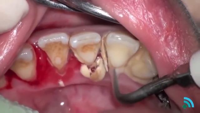 Удаление зубного камня с помощью ультразвука (Removing dental plaque) смотреть онлайн