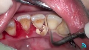 Удаление зубного камня с помощью ультразвука (Removing dental plaque)