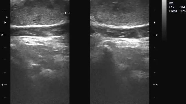 CASE 214 TB cervical lymphadenitis смотреть онлайн