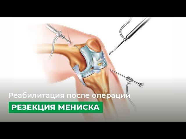 Реабилитация после операции 