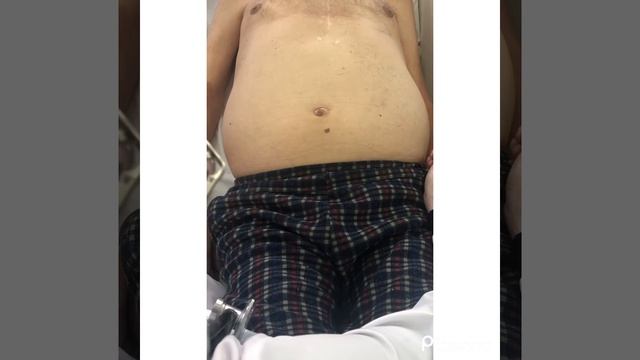 Уроки пропедевтики: диагностика асцита #лекции #диагностика #асцит #медицина смотреть онлайн