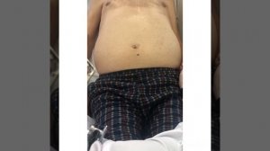 Уроки пропедевтики: диагностика асцита #лекции #диагностика #асцит #медицина