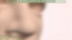 Ринопластика
