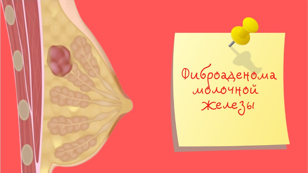 Фиброаденома молочной железы | Лечение без операции