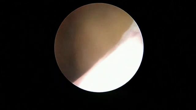 Дефект миометрия после фокусной ультразвуковой аблации по поводу миомы матки смотреть онлайн