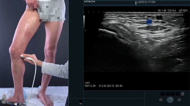 Вебинар, ультразвуковое исследование вен нижних конечностей смотреть онлайн
