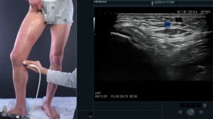 Вебинар, ультразвуковое исследование вен нижних конечностей