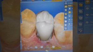 Восстановление сломанного зуба на аппарате #Cerec