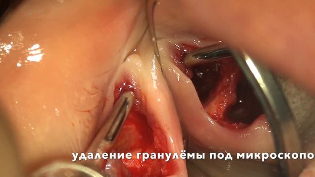 удаление гранулёмы не определяемой на рентгене при одномоментной имплантации под микроскопом смотреть онлайн