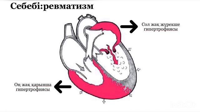 Митральды стеноз жүрек ақаулары Митральный стеноз қазақша смотреть онлайн