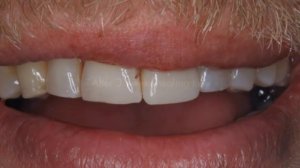 Одномоментная имплантация в области переднего зуба