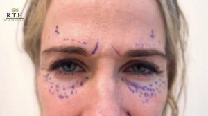 Эндоскопическая подтяжка лица .