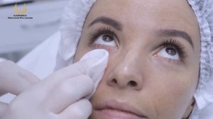 Коррекция носослезной борозды