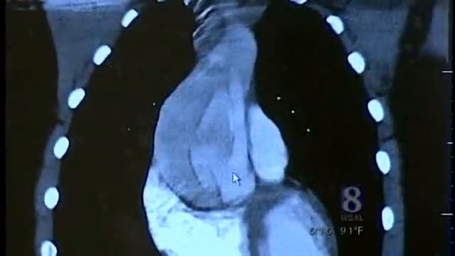 Adams County Teen Survives Rare Aorta Condition смотреть онлайн
