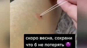 Как вытащить клеща. Укусил клещ.