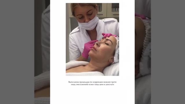Круговая подтяжка препаратом Скульптра смотреть онлайн
