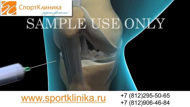Артроскопия. Повреждение медиального мениска, мениск смотреть онлайн