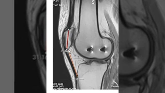 Patella alta and patella baja смотреть онлайн