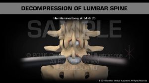 Декомпрессия поясничного отдела позвоночника