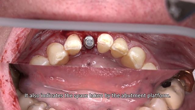 Dr. Stefan P. Hicklin: Straumann® BLT Ø 2.9 mm implant смотреть онлайн