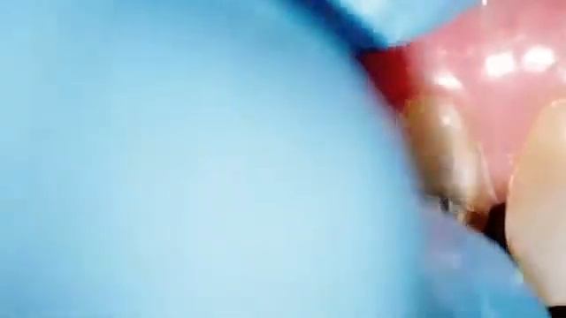 Стоматология. Фиксация коронок. Неадгезивный протокол. смотреть онлайн