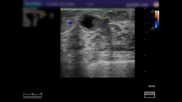 Внутрипротоковая папиллома молочной железы (УЗИ) смотреть онлайн
