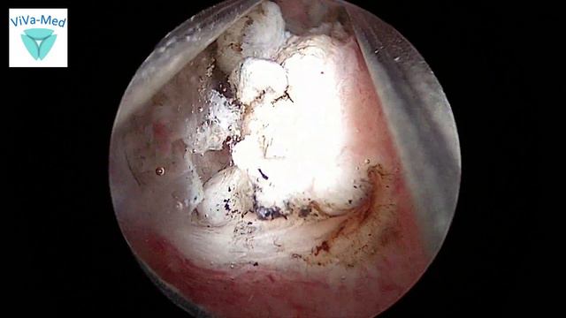 Myomectomy in a virgin (ReseCare) смотреть онлайн